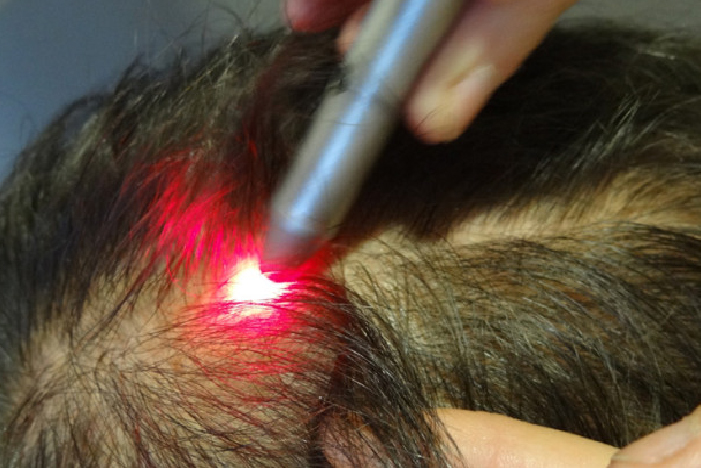 tratamiento capilar a laser 